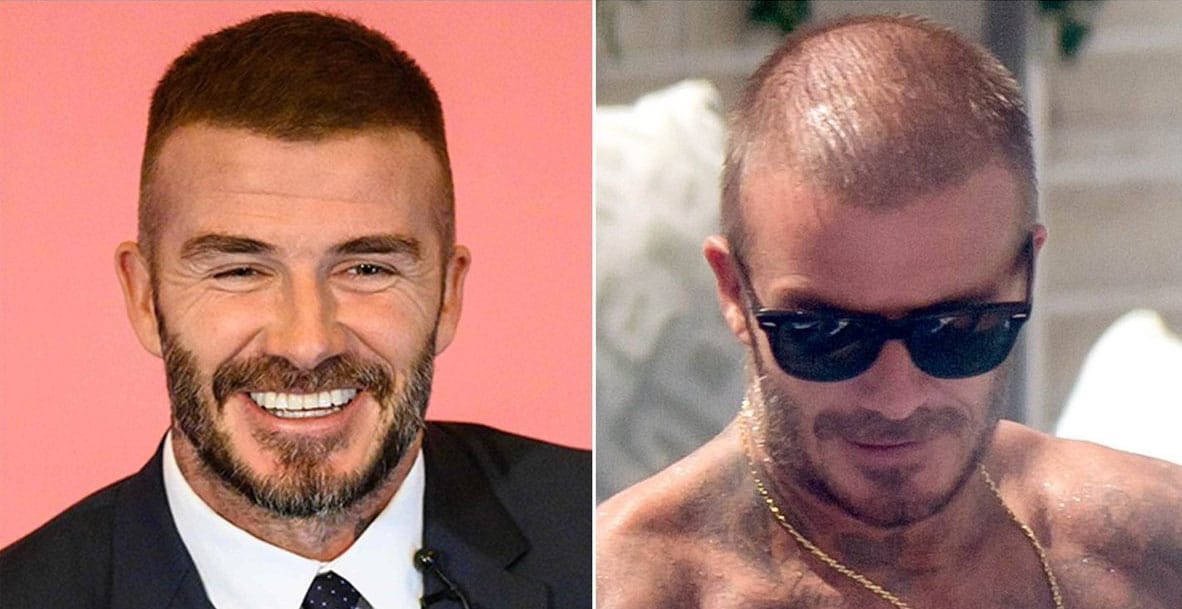 Celebrity Hair Transplant Scar