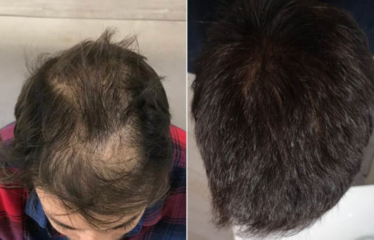 Before and after hair transplant: Step-by-Step Situation - RepHair