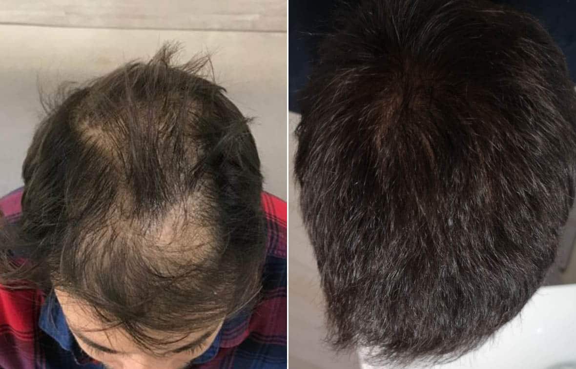 Before and after hair transplant Step-by-Step Situation - Desmoderm