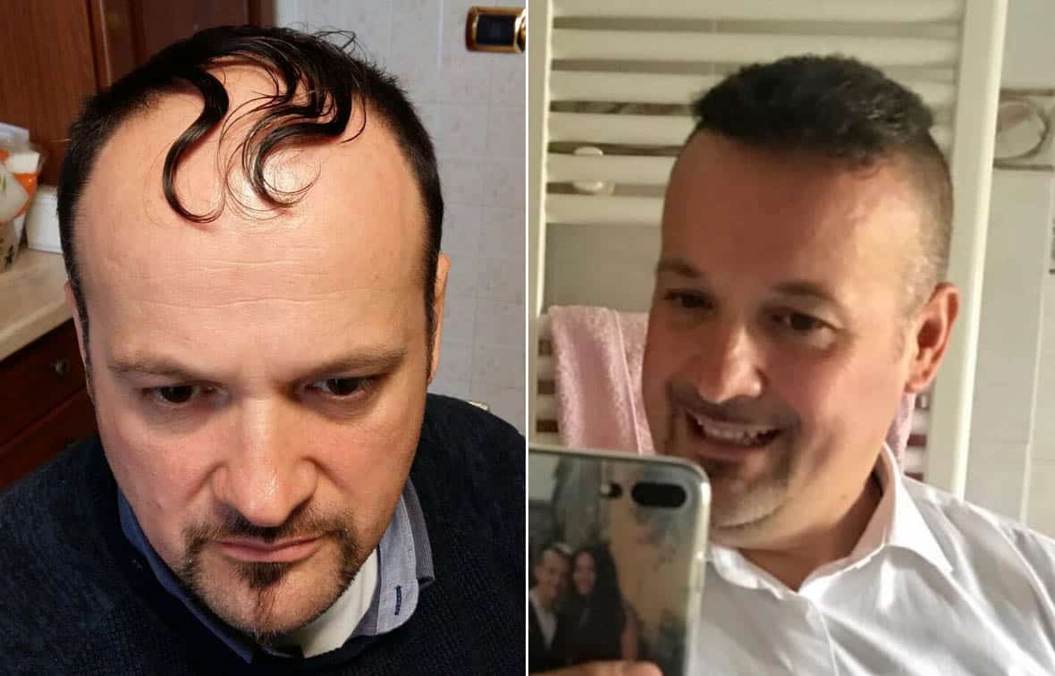 are hair transplants noticeable