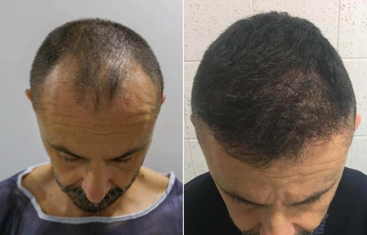 Post Op Recovery Photographs – 2 Weeks After FUE Hair Transplant Procedure