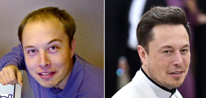 celebrity hair transplants before and after