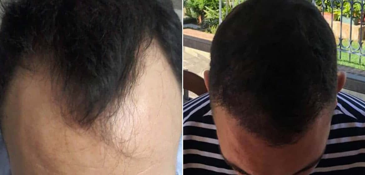 Shock Loss After Hair Transplant - MCT