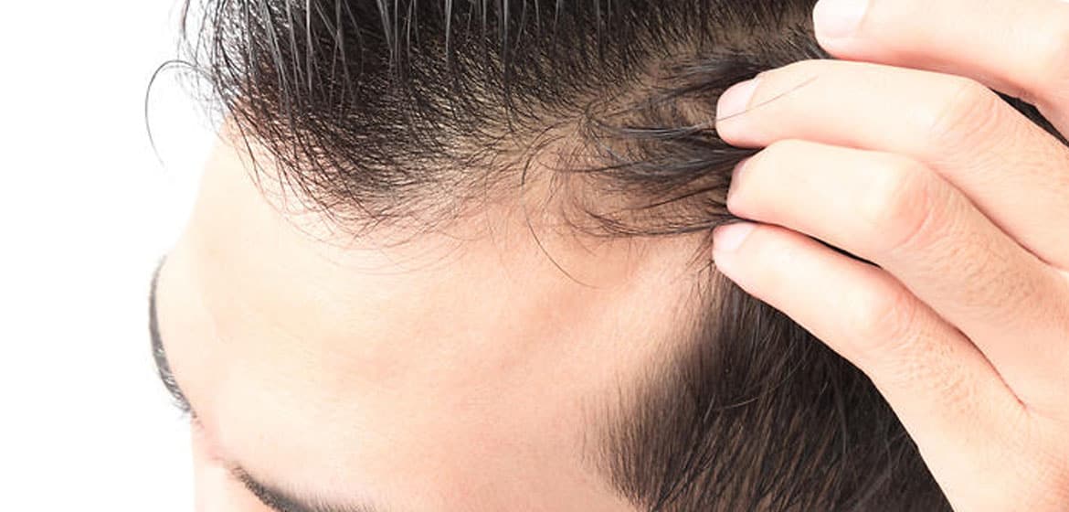 Hairline signs receding Receding Hairline: