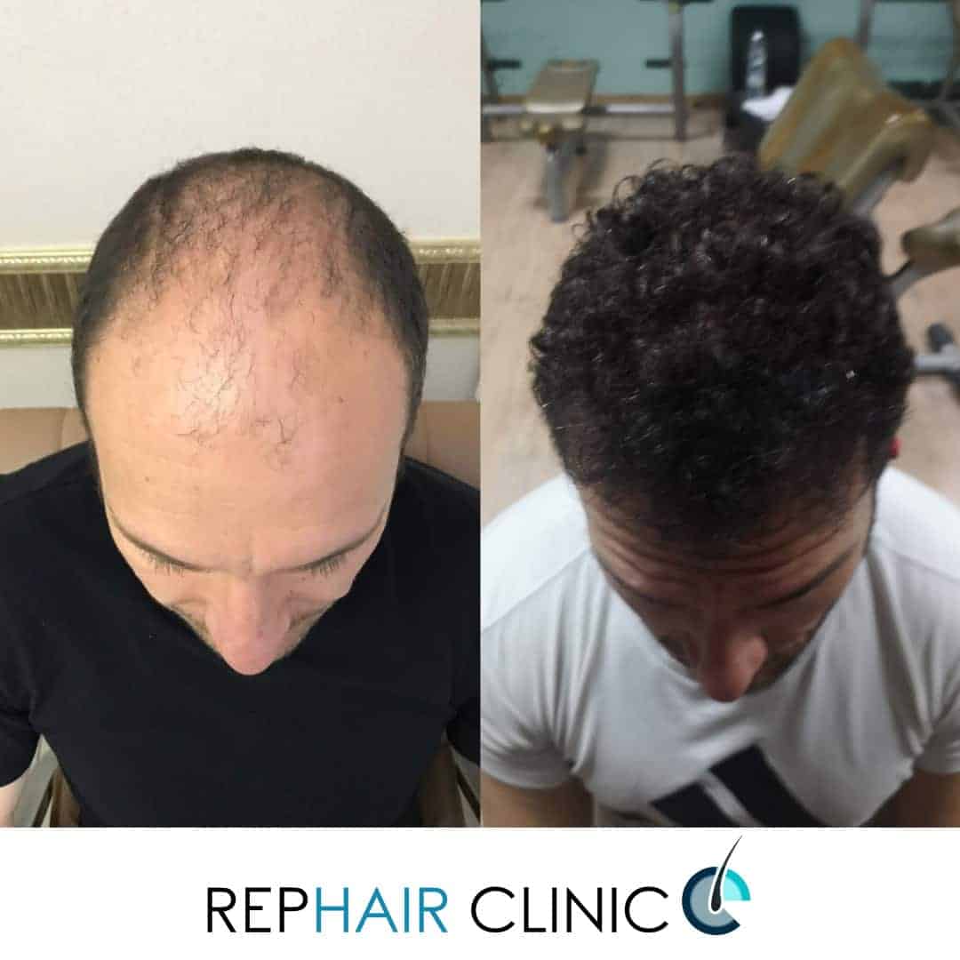 Before and after hair transplant: Step-by-Step Situation - RepHair