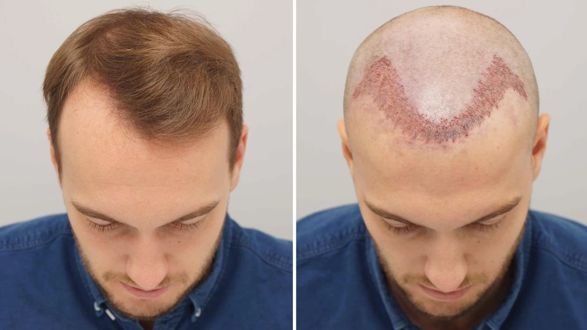 Here's How to Tell If Your Hairline Is Receding