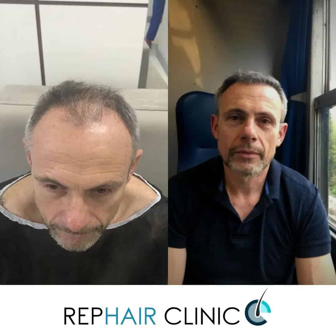 Before and after hair transplant Step-by-Step Situation - Desmoderm