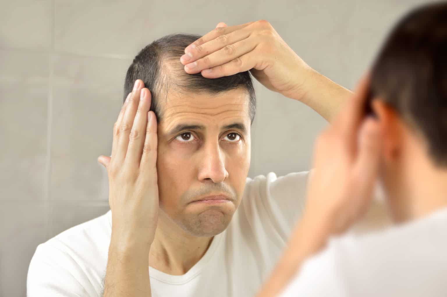 Receding hairline: Causes, Symptoms and Treatment - RepHair