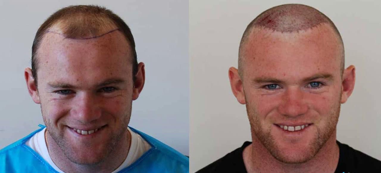 Wayne Rooney Hair Transplant