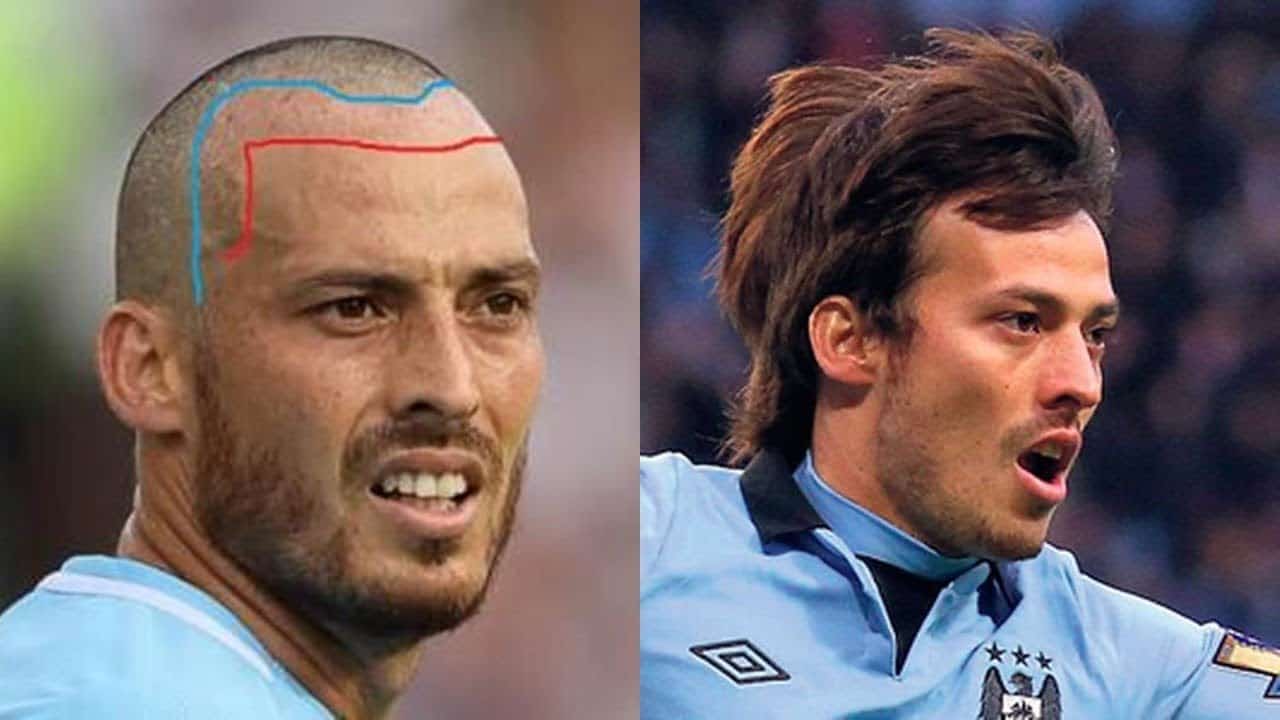 David Silva Hair Transplant Everything You Need To Know  Wimpole Clinic