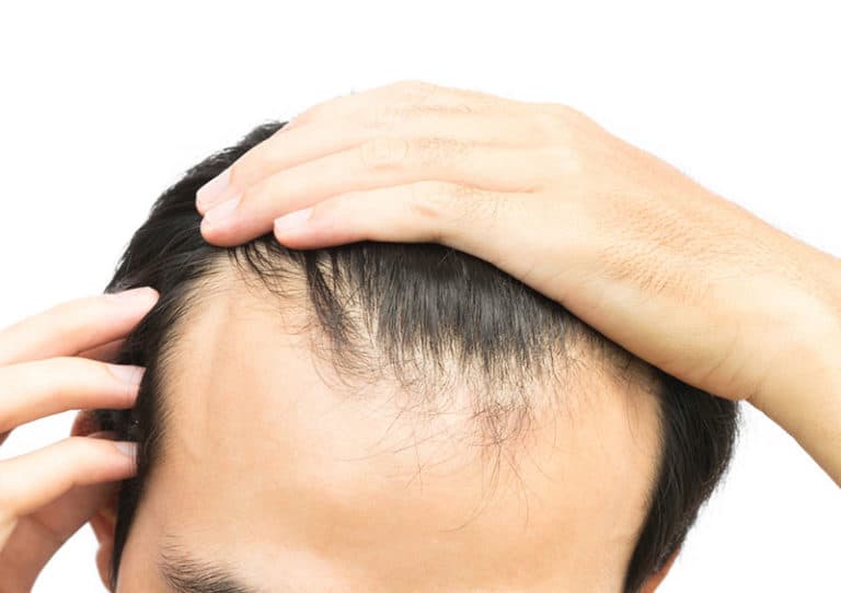 What Causes Hair Loss 10 Major Reasons With Treatments Rephair