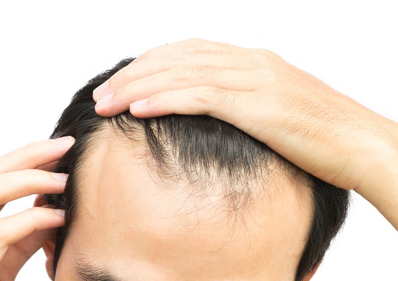Causes of hair loss in men and women