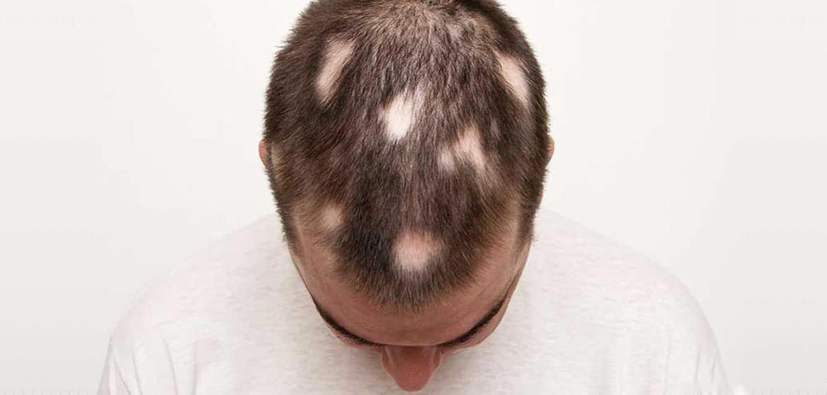 PDF Cyclosporine Ainduced hair repigmentation in a patient with  dermatitis A case report with a review of the literature