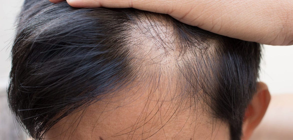 Signs and Symptoms of Alopecia