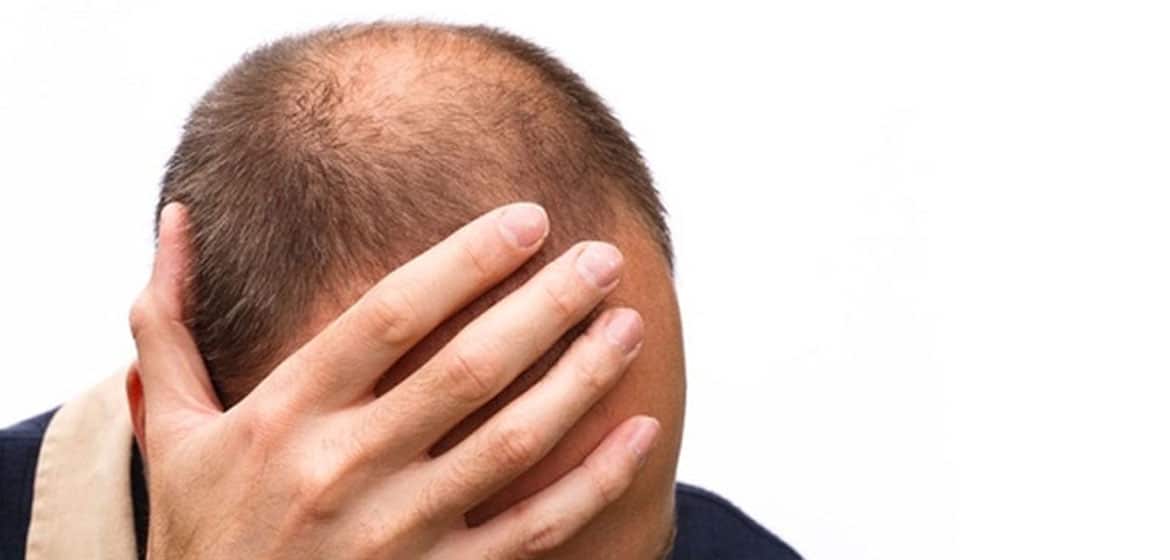 Hair Loss Stress 5 Major Causes With Treatment And Prevention