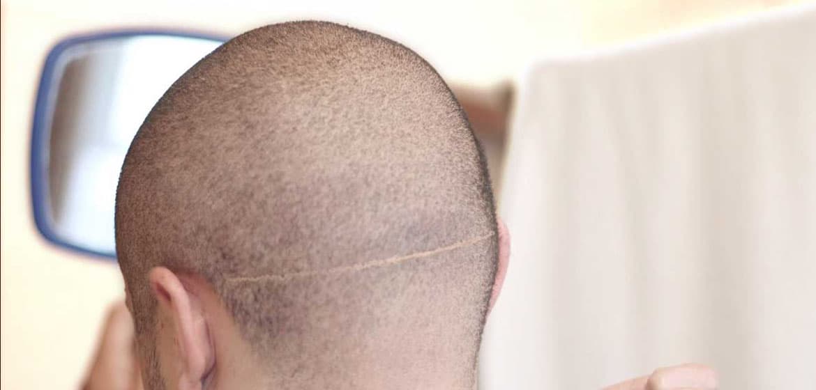 hair transplant scar