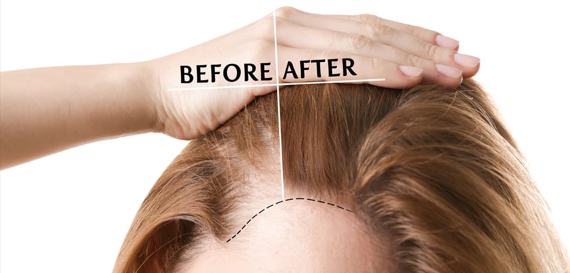 Alopecia femminile: le calvizie non colpiscono solo gli uomini