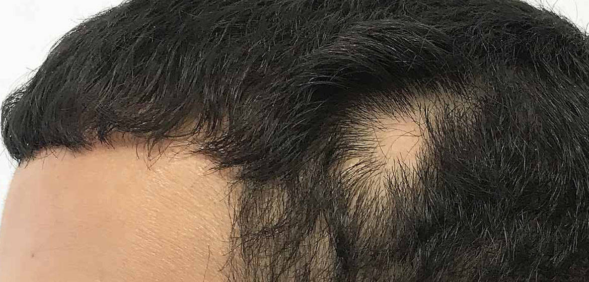 Hair transplant on scars removal Process