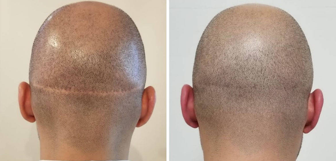 Fut And Fue Comparison Of Graft Scar And Differences Cosmeticium