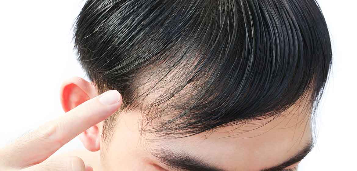 What is Androgenetic Alopecia?