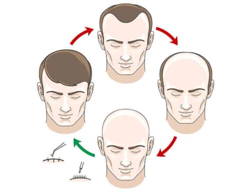 How long do hair transplant last? Recovery and Expectations
