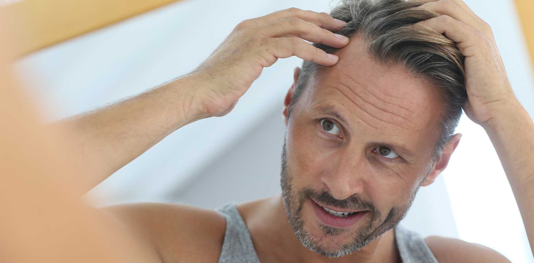 Higher than normal levels of DHT slowly miniaturize the hair follicles with time and causes the loss of hair permanently. The receding hairline typically shows a horseshoe shaped pattern in men and a bald patch on crown for women.