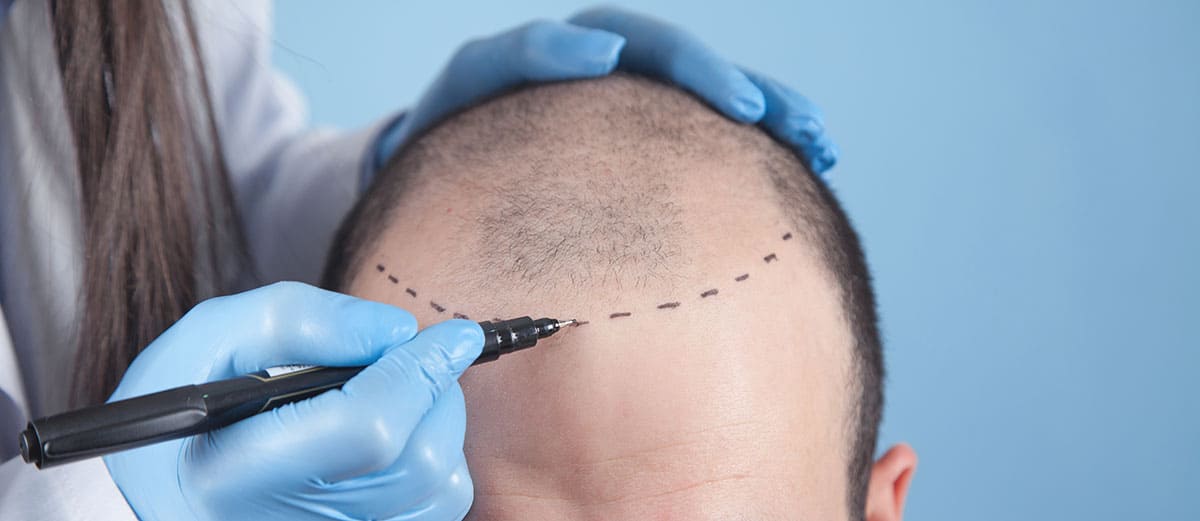 A hair transplant can last permanently whether a client receives an FUE or FUT procedure. The permanent zone from which hair follicles are taken earned its name because the hair is genetically programmed not to fall out. 