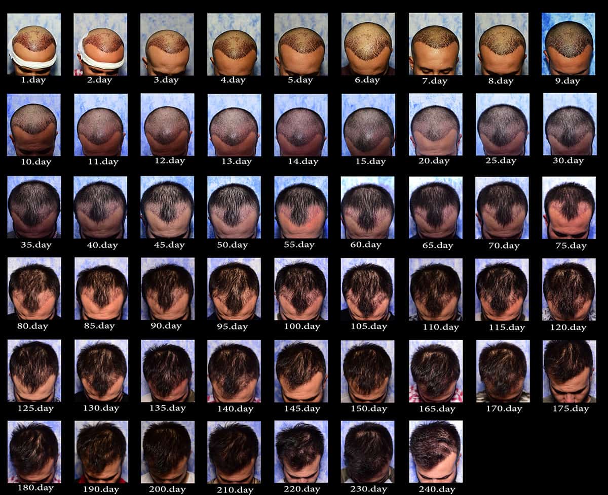 Hair transplant timeline discover the evolution month by month