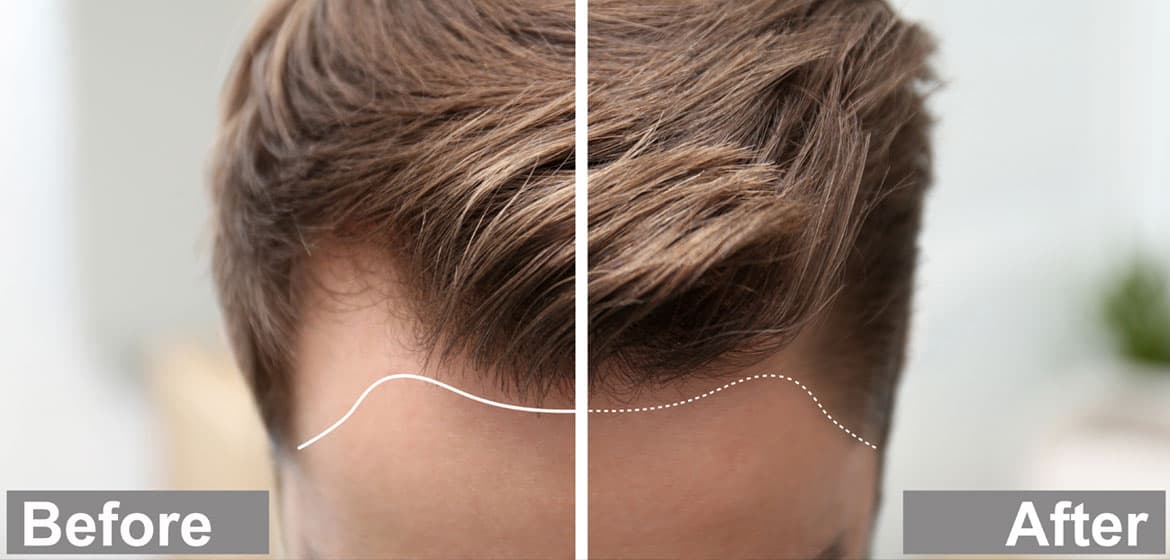 Mature hairline is the natural phenomenon which is common across teenagers.