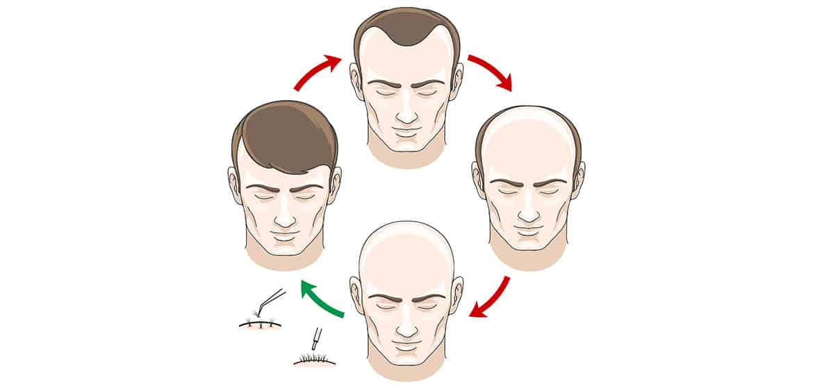 Duration of Mature Hairline. Cycle of mature hairline