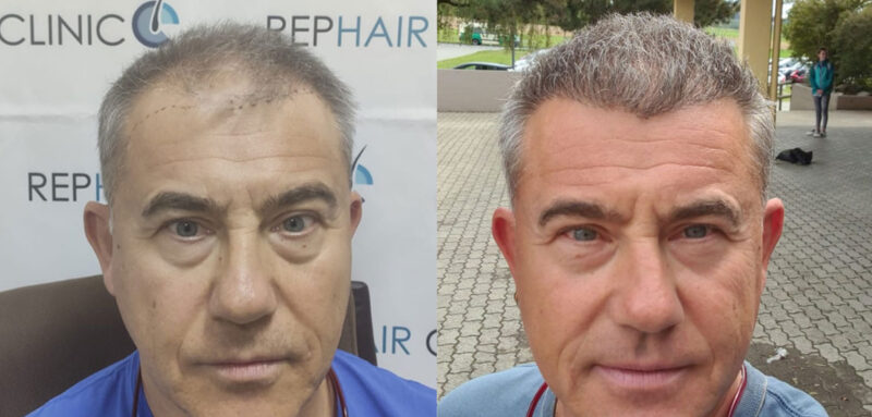 hair implants
