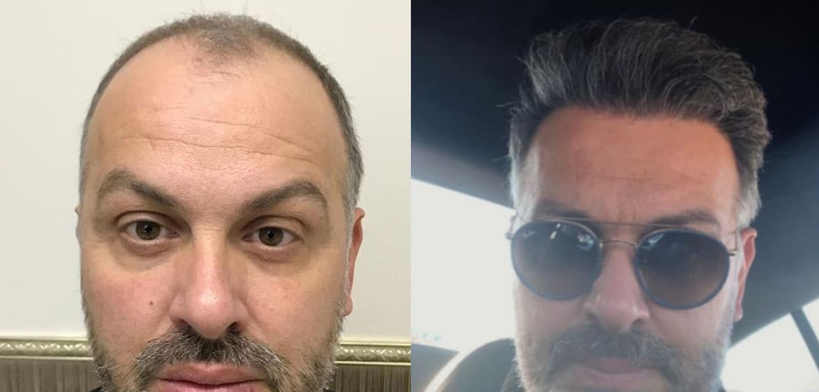 Hair Transplant Before After